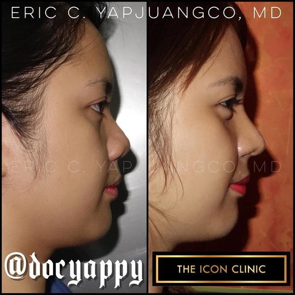 secondary closed rhinoplasty secondary closed rhinoplasty