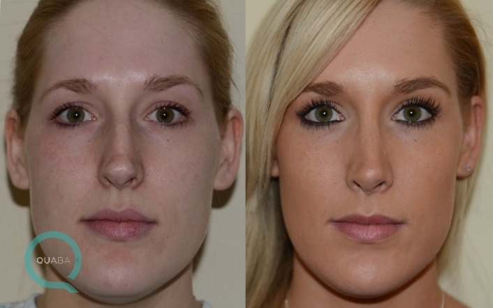 rhinoplasty doctor rhinoplasty doctor