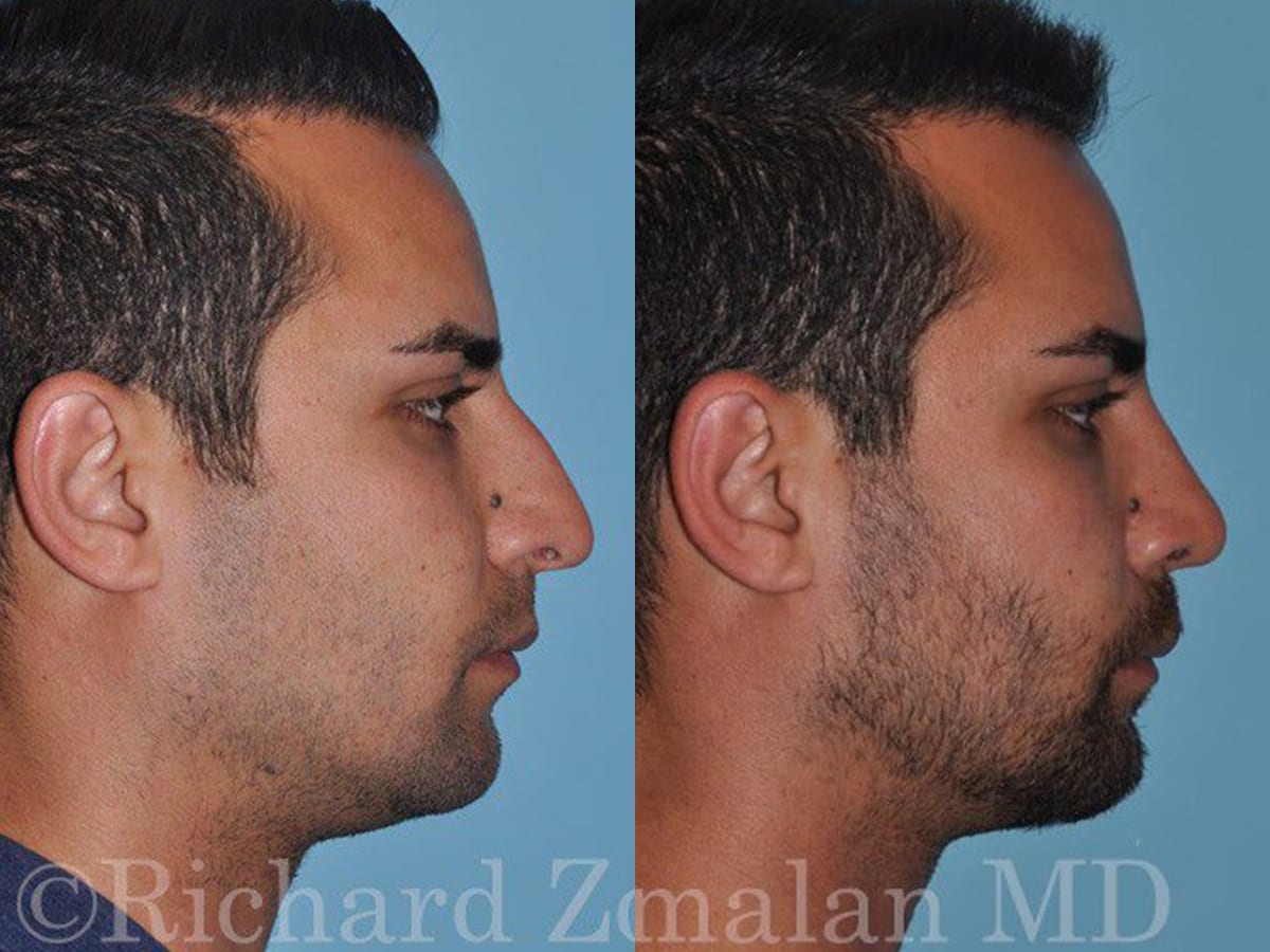 rhinoplasty doctor rhinoplasty doctor